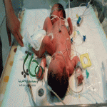 "عسير"مستشفى أبها للولادة يشهد ولادة طفلين سياميي لسيدة يمنية 