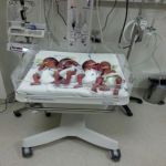 مستشفى أبها العام يشهد ولادة 4 توائم لسيدة مصرية