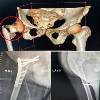 جراحة العظام في الأسياح العام ينجح في إعادة تثبيت كسر لخمسيني