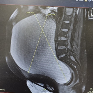 في القصيم استئصال ورم سرطاني ضخم أدى إلى إزاحة أعضاء البطن لمريضة سبعينية